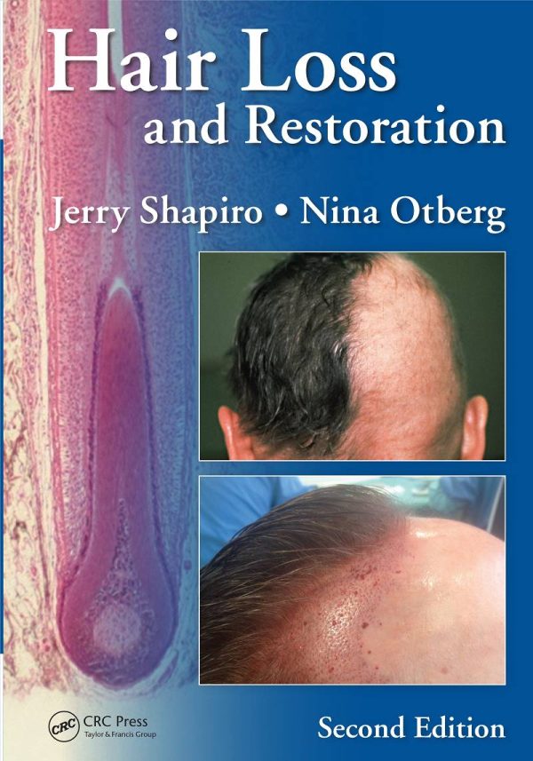 Hair Loss and Restoration 2nd Edition by Jerry Shapiro